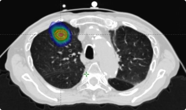 定位放射線治療（SRT：Stereotactic Radiotherapy）